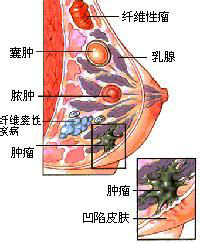 预防导管内乳头状瘤